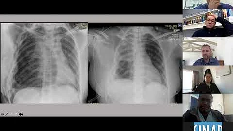 Sinapi Chest Drain during Trauma Webinar  31July2020