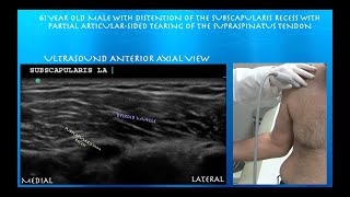 Subscapularis Recess /Bicipital Sheath Distension and Partial Supraspinatus Tear