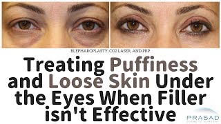 For more on lower eyelid surgery:
https://puffyeyes.com/quick-recovery-lower-eyelid-eye-bag-surgery/for
under eye fillers, please go to: https://puff...