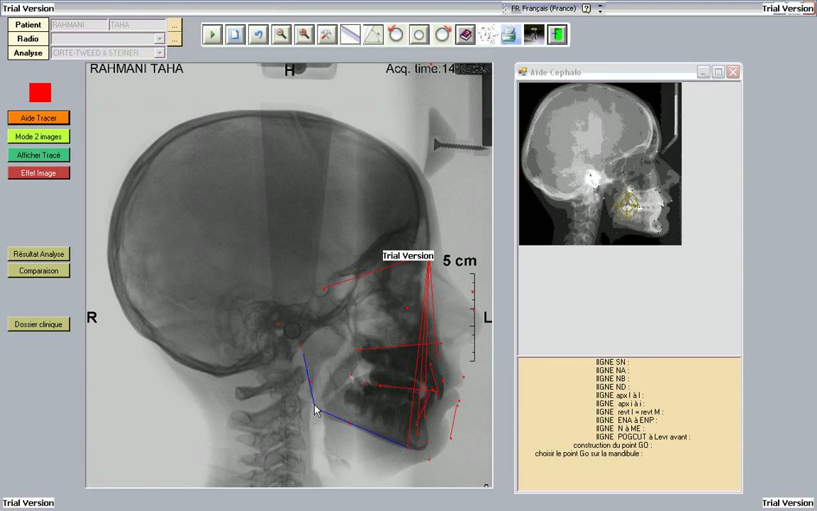 PRESENTATION DE CEPHALOSOFT LOGICIEL DE TRACE CEPHALOMETRIQUE
