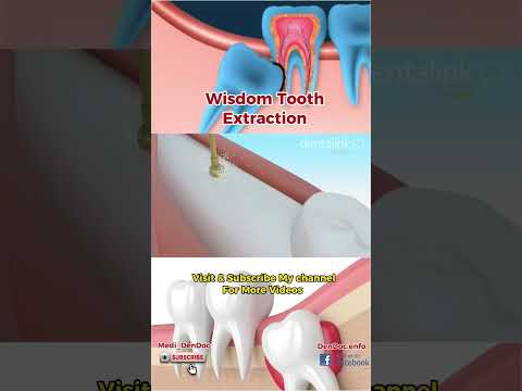 Wisdom tooth Cause