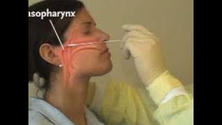 Collection of Nasopharyngeal Specimens with the Swab Technique | NEJM