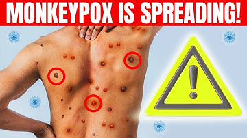 Monkeypox: What It Is And How to Protect Yourself