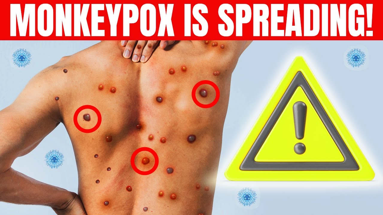 Monkeypox: What It Is And How to Protect Yourself