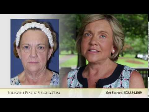 Denise — Neck lift · age 65