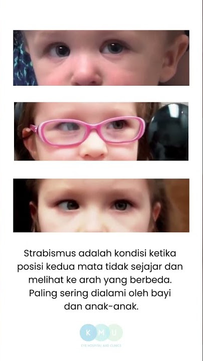 Apa Itu Strabismus?