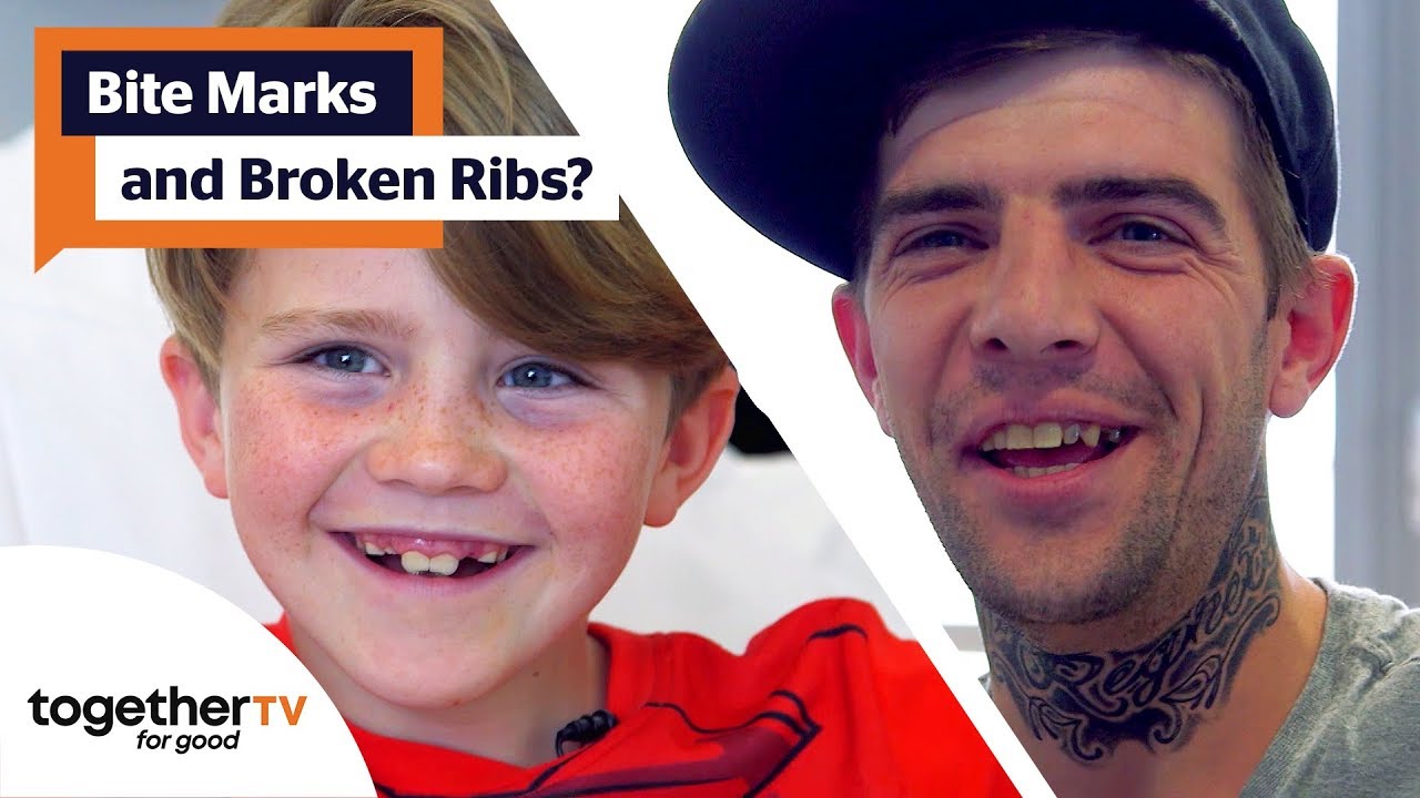 Has Human Bite Marks Patient Suffered Broken Ribs - or Worse? | Secret ...