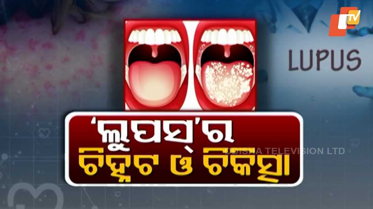 DOCTOR DOCTOR || ଲୁପସ୍‌ର ଚିକିତ୍ସା ଓ ଲକ୍ଷଣ କ’ଣ ଜାଣନ୍ତୁ