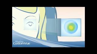 Advanced Customvue Lasik Patient Walk-Thru.wmv