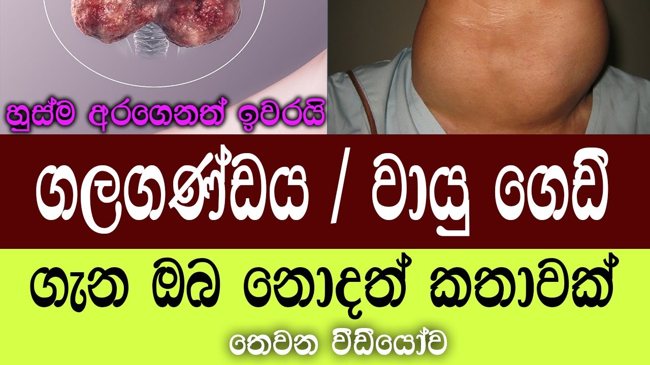 ගලගණ්ඩය හෙවත් වායු ගෙඩි Goiters තයිරොයිඩ් ග්රන්ථියේ රෝග වීඩියෝ