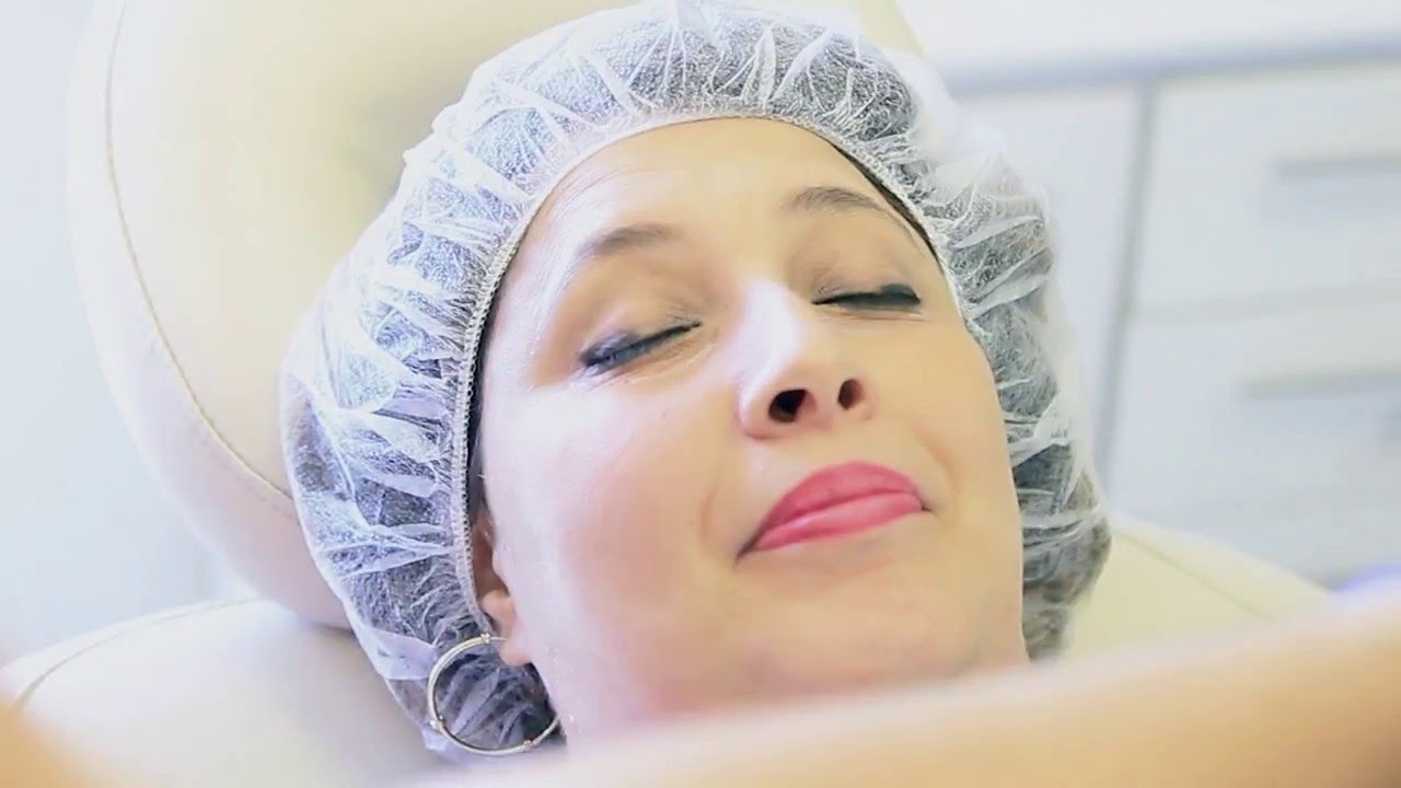 Comblement de cernes creux par le REDENSITY par Dr Mohamed Guessous @ Guess Clinic