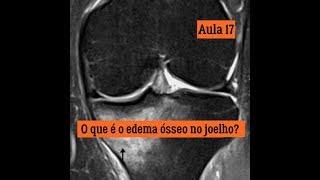 Médula extenso subcondrales de edema