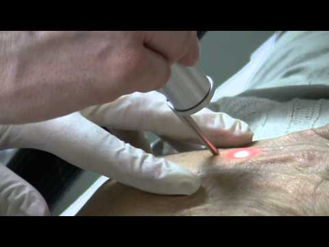 Laser Brown Spot (Lentigo) Destruction At Las Vegas Dermatology