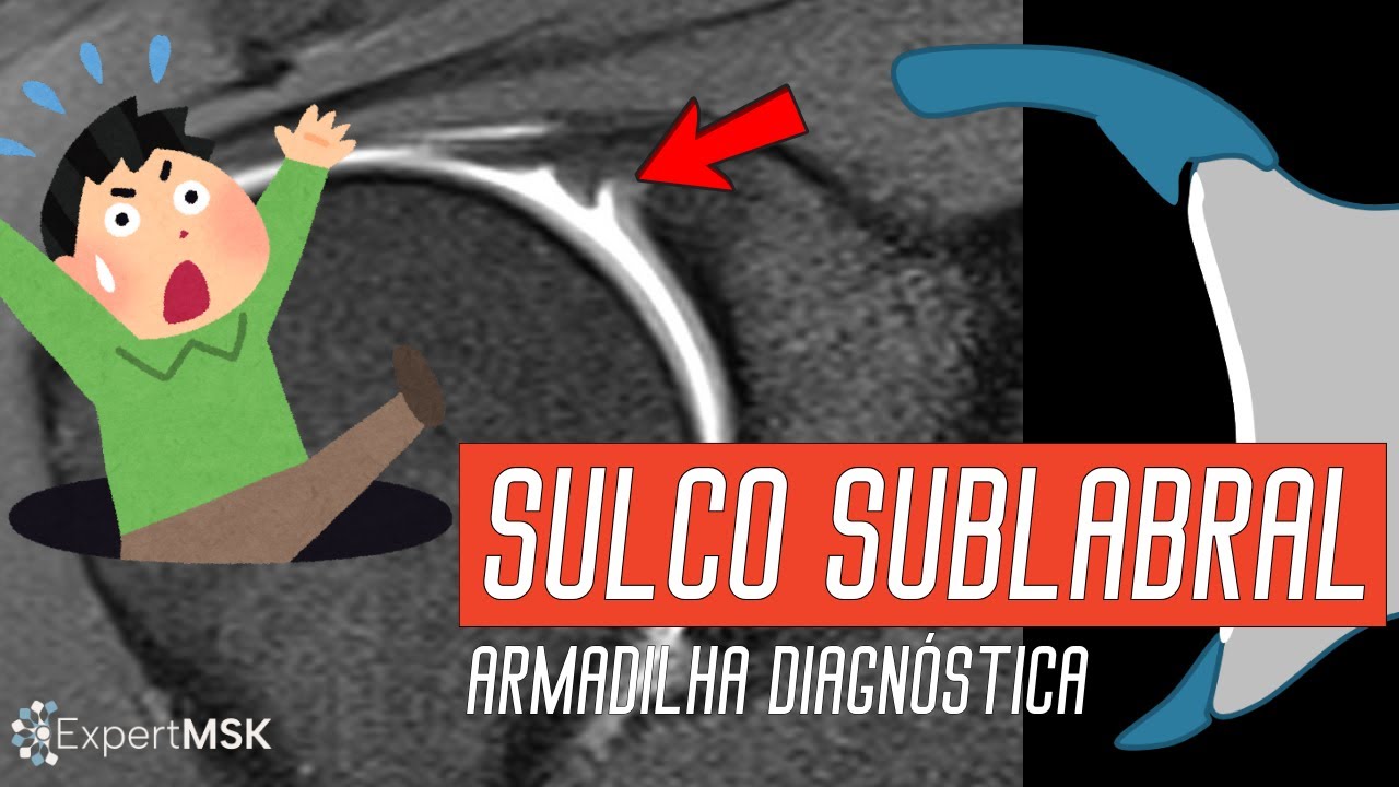 SULCO SUBLABRAL: Variação Anatômica do Lábio Glenoidal