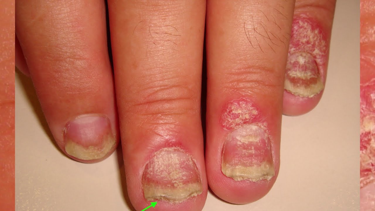 Псориаз ногтей: фото на руках и ногах, ногтевой грибок - YouTube