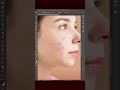 Remove Pimples &amp; Acne in Seconds 😱  Photoshop