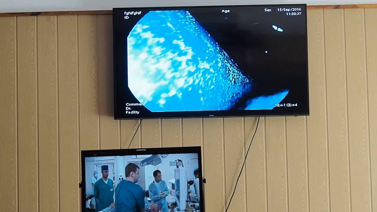 03Live Ткаченко ОБ EUS Лейомиома пищевода - YouTube