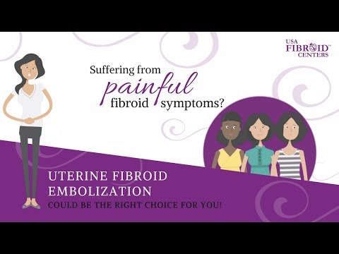 Uterine Fibroid Embolization UFE At USA Fibroid Centers 