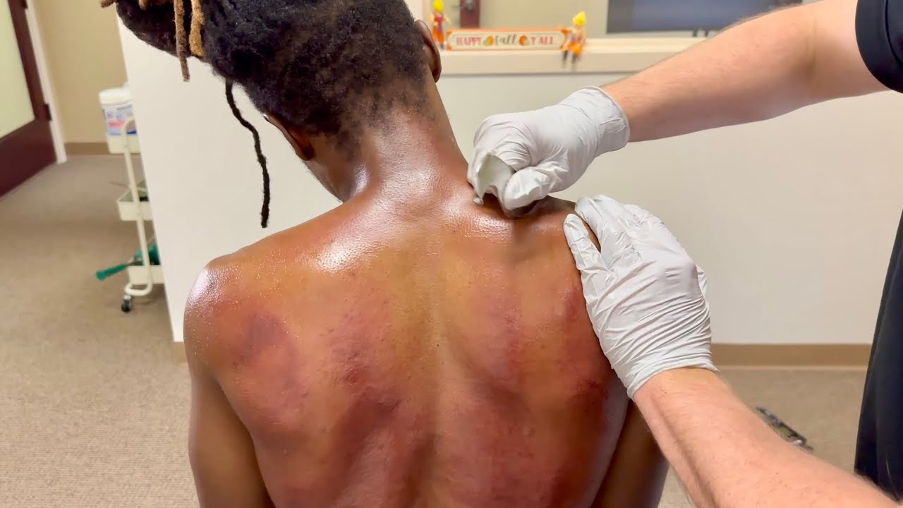 KNOTS ON KNOTS FROM HEAVY REPETITIVE MOTIONS GET SCRAPED OUT