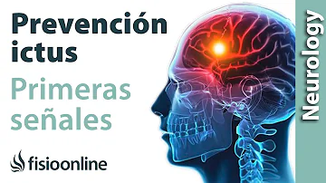 ¿Se puede tener dolor de cabeza durante días antes de un ictus?