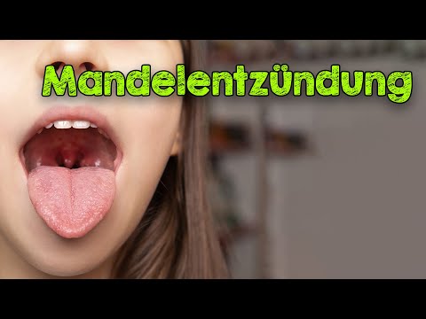 Video: Können Sie Wucherungen auf Ihren Mandeln bekommen?