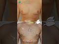 Moderate Gynecomastia Before &amp; After: The 3D Technique!