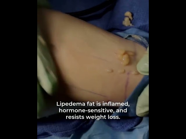This is for everyone who has been told to "just eat less and move more." 👇 Lipedema fat plays by