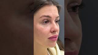 9-е сутки после ринопластики и лифтинга лица🔥🔥🔥 #dromaradigezalov #ринопластика #брови