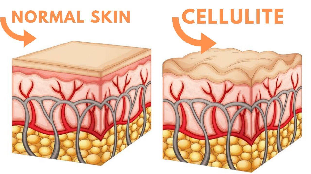 Some Ideas on Everything You Need To Know About Getting Rid Of Cellulite You Need To Know thumbnail