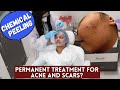 I got STRONG Chemical Peeling at the Clinic for ACNE | Is it a Permanent cure?#SkinTalkWSarah EP 20