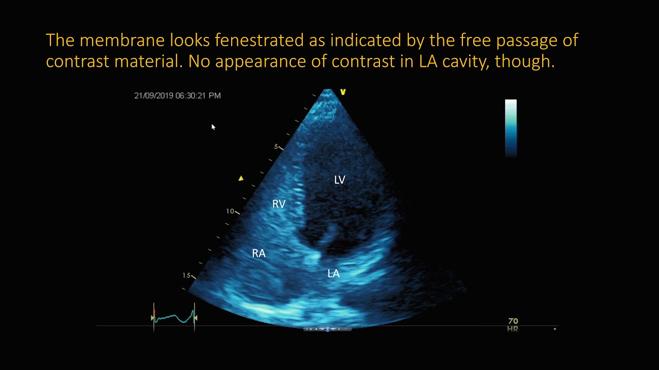 Eustachian valve  VS Cortriatriatum Dexter: 3D echo findings