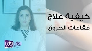 كيفية علاج فقاعات الحروق