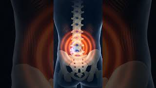 All about "Hyperlordosis" Pt.2  #backexercises #backpain #healthtips #posturecheck