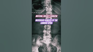 Breast Cancer Metastasis #doctor #medical #radiology