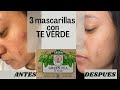 3 Mascarillas de TE VERDE para eliminar ACNE en una semana || Beneficios de TE VERDE || elimina ACNE