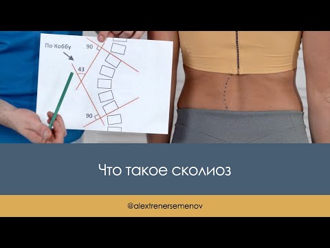 Что такое сколиоз?