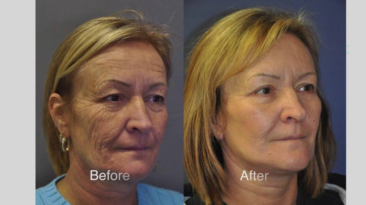 How To Avoid A Poor Facelift Result