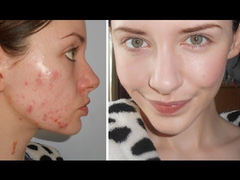 Food + Drink Tips For Acne & Products I&#;ve Used For Clear Skin