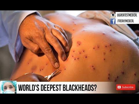 Back Blackheads?  Buckshot?  Cystic Acne?