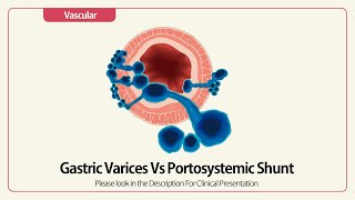 Linear EUS: Gastric Varices Vs Portosystemic Shunt