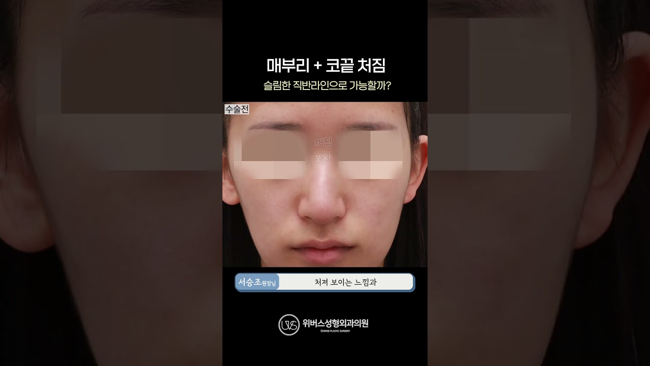 [Вивэрс Гоо сайхны мэс заслын клиник] Тахир хамар, унжсан хамарны үзүүр