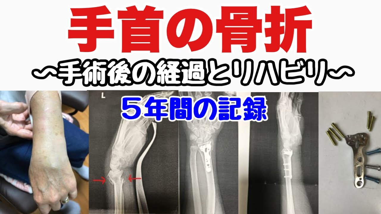 【手首の骨折】手術後の経過とリハビリ〜5年間の記録（橈骨遠位端骨折の手術とリハビリ）〜
