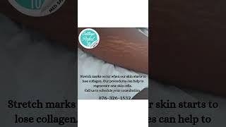 Laser stretch marks use fractional laser technology to stimulate collagen &amp; elastin production.