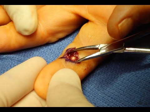 Live Surgery: Foreign Body (BB) Removal from Finger