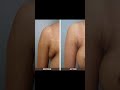 Underarms fat Removal | Before and After | #fatremoval #trending #plasticsurgeon #trending #fatloss