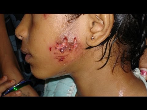 Video: Hindi Maipaglaban - Nag-save Ng Buhay Ang Mga Bakuna Sa Rabies