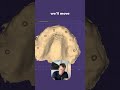 exocad Design Session - Seth Potter