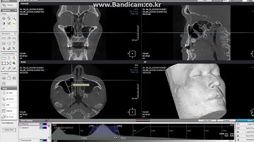 Maxillary Sinus Segmentation OnDemand3D