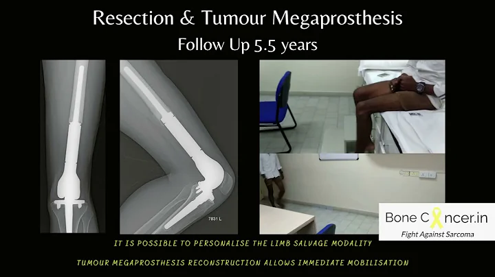 Treatment for Bone Cancer (Osteosarcoma) Femur: Limb Salvage Tumor Megaprosthesis, Dr Srimanth B S - DayDayNews