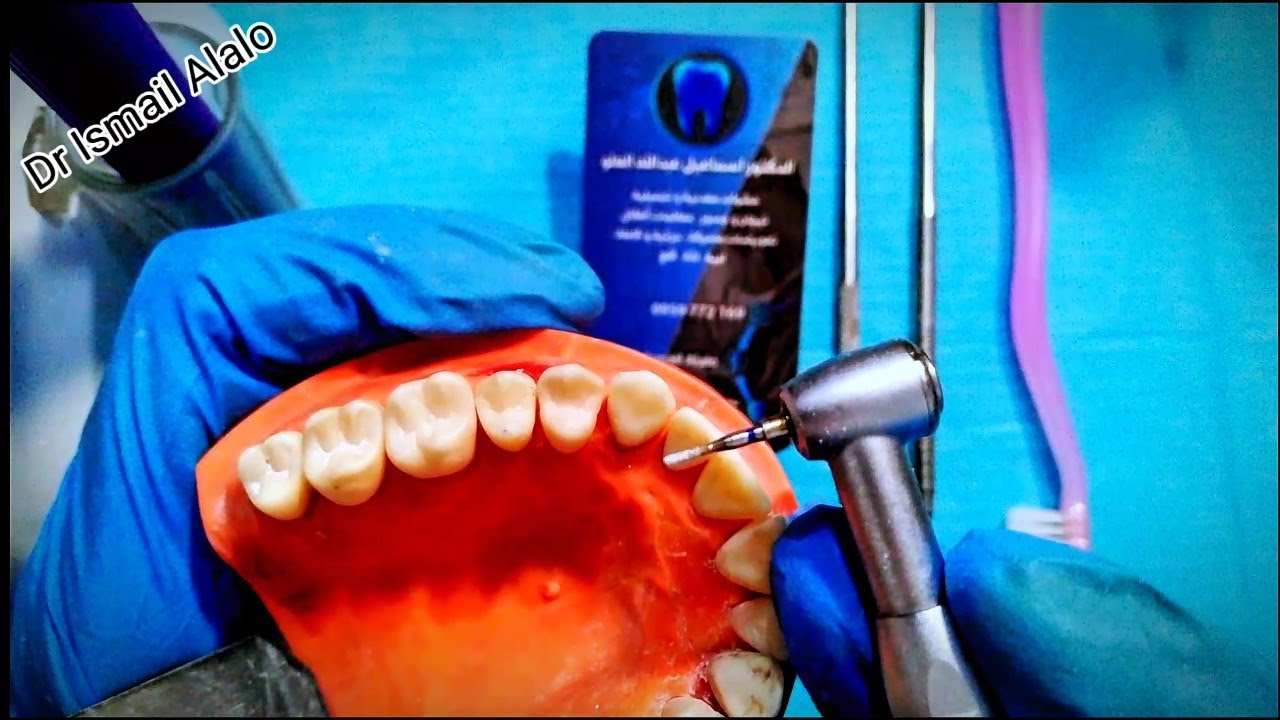 تحضير ضاحك اول علوي لإستقبال تاج خزفي ملفحPreparing the first upper premolar